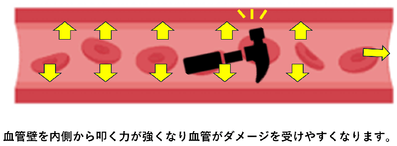 高血圧イメージ